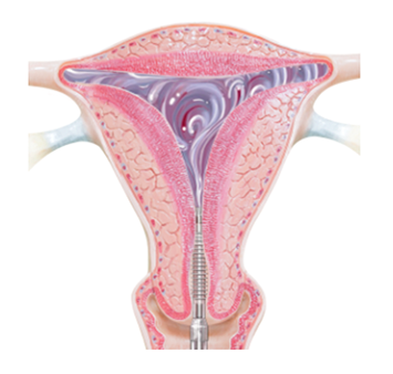 genesysHTA-uterus