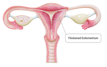 thickened-endometrium