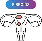 fibroids_up
